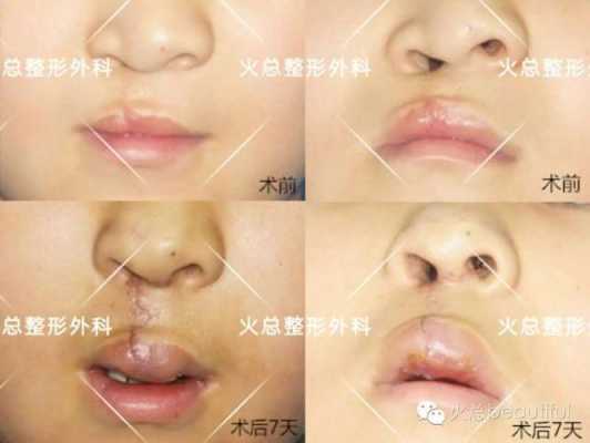 胎儿兔唇是什么原因造成的(兔唇修复手术要多少钱) 第2张 胎儿兔唇是什么原因造成的(兔唇修复手术要多少钱) 第2张