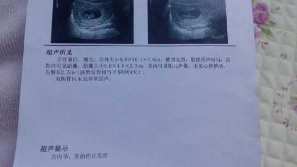 胎儿缺氧多久会胎停(胎儿缺氧多久会胎停孕晚期呢) 第2张 胎儿缺氧多久会胎停(胎儿缺氧多久会胎停孕晚期呢) 第2张
