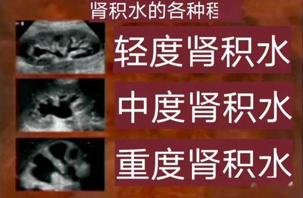 胎儿肾积水引产人多吗(胎儿肾积水跟孕妇生气有关系吗) 第2张 胎儿肾积水引产人多吗(胎儿肾积水跟孕妇生气有关系吗) 第2张