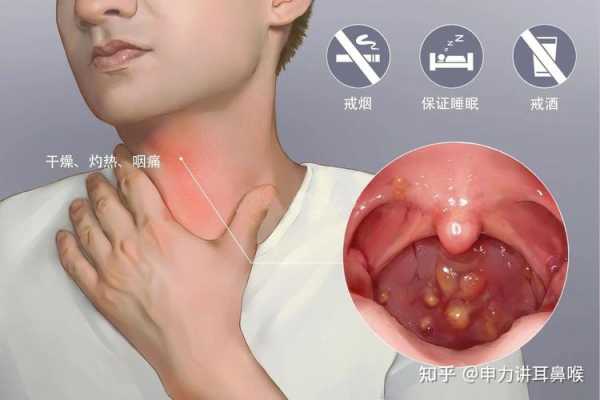 孕期咽喉炎咳嗽厉害怎么办,孕妇咽炎对胎儿有影响吗 第1张 孕期咽喉炎咳嗽厉害怎么办,孕妇咽炎对胎儿有影响吗 第1张