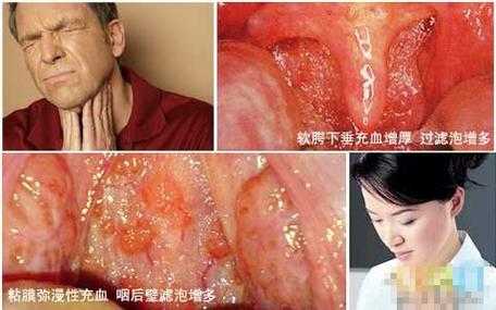 孕期咽喉炎咳嗽厉害怎么办,孕妇咽炎对胎儿有影响吗 第2张 孕期咽喉炎咳嗽厉害怎么办,孕妇咽炎对胎儿有影响吗 第2张