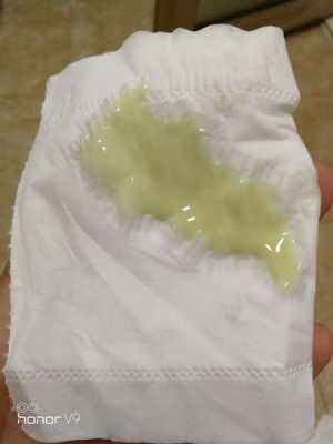 孕期白带黄绿色正常吗?怎么办, 第2张 孕期白带黄绿色正常吗?怎么办, 第2张