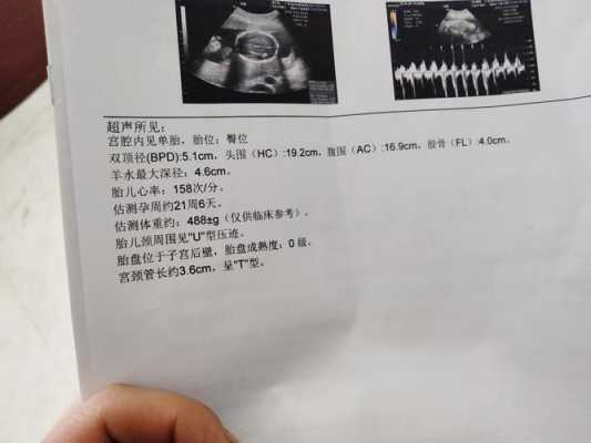 我做四维彩超结果是胎儿颈部见u型压迹这是什么意思,胎儿颈部未见u型压迹什么意思正常吗 第2张 我做四维彩超结果是胎儿颈部见u型压迹这是什么意思,胎儿颈部未见u型压迹什么意思正常吗 第2张