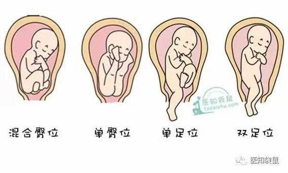 32周胎儿(32周胎儿的头在哪里?怀孕32周,臀位怎么办) 第3张 32周胎儿(32周胎儿的头在哪里?怀孕32周,臀位怎么办) 第3张