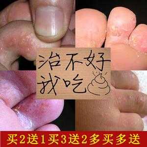孕妇用什么治脚气最好？孕妇可以使用治脚气的药吗,孕期脚气可以用什么药膏  第2张