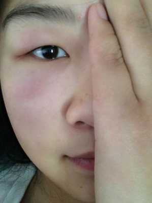 孕期眼睛疼是怎么回事(孕期眼睛疼是怎么回事) 第1张 孕期眼睛疼是怎么回事(孕期眼睛疼是怎么回事) 第1张