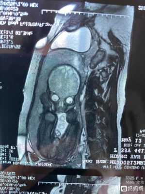 怀孕多少周做核磁共振,胎儿核磁共振对宝宝有影响吗  第2张