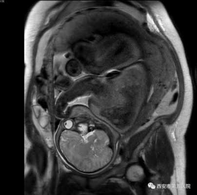 怀孕多少周做核磁共振,胎儿核磁共振对宝宝有影响吗  第1张