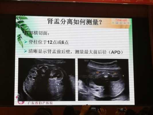 胎儿双肾分离(胎儿双肾分离是怎么回事) 第1张 胎儿双肾分离(胎儿双肾分离是怎么回事) 第1张