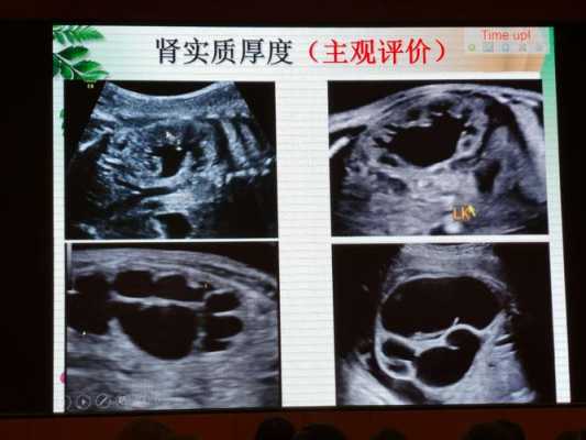 胎儿双肾分离(胎儿双肾分离是怎么回事) 第2张 胎儿双肾分离(胎儿双肾分离是怎么回事) 第2张