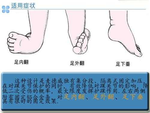 胎儿足内翻(胎儿足内翻是什么原因导致的) 第2张 胎儿足内翻(胎儿足内翻是什么原因导致的) 第2张
