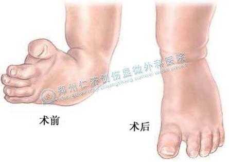 胎儿足内翻(胎儿足内翻是什么原因导致的) 第1张 胎儿足内翻(胎儿足内翻是什么原因导致的) 第1张