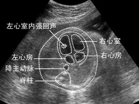 胎儿心室强光点（胎儿心室强光点是怎么回事）  第1张