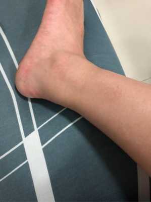 孕期脚肿是男孩还是女孩(孕期脚肿是男孩还是女孩论坛) 第2张 孕期脚肿是男孩还是女孩(孕期脚肿是男孩还是女孩论坛) 第2张