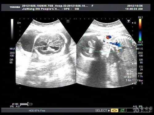 胎儿脑积液（胎儿颅后窝池宽是怎么回事？正常值是多少）  第1张