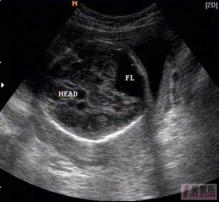 胎儿脑积液（胎儿颅后窝池宽是怎么回事？正常值是多少）  第2张