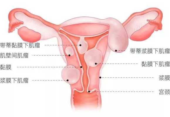 怀孕期间得了子宫肌瘤该怎么办,好多人发现怀孕后有子宫肌瘤  第2张