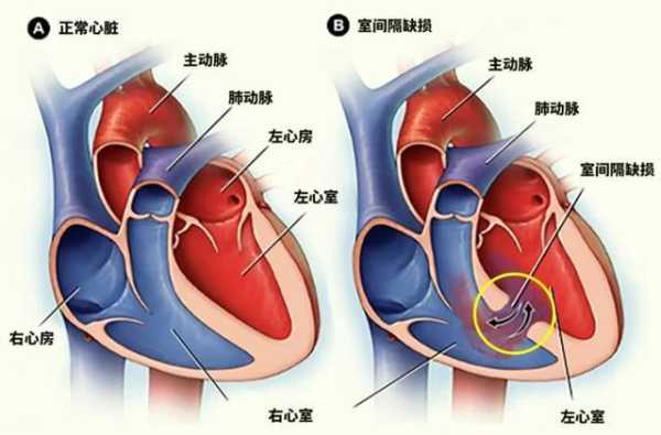 胎儿肺动脉狭窄(胎儿肺动脉狭窄能不能要) 第1张 胎儿肺动脉狭窄(胎儿肺动脉狭窄能不能要) 第1张