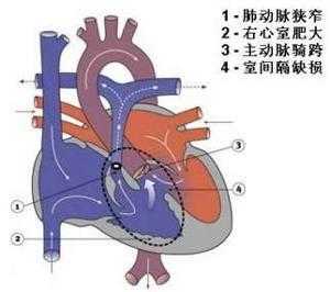 胎儿肺动脉狭窄(胎儿肺动脉狭窄能不能要) 第2张 胎儿肺动脉狭窄(胎儿肺动脉狭窄能不能要) 第2张