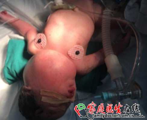胎儿淋巴水囊瘤(胎儿颈部水囊瘤无水肿是怎么回事?能否治疗) 第2张 胎儿淋巴水囊瘤(胎儿颈部水囊瘤无水肿是怎么回事?能否治疗) 第2张