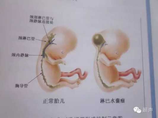 胎儿淋巴水囊瘤（胎儿颈部水囊瘤无水肿是怎么回事?能否治疗）  第1张