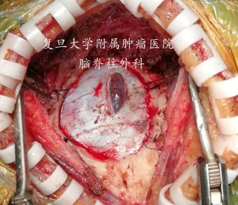 胎儿蛛网膜囊肿（胎儿蛛网膜囊肿该不该生下来）  第2张