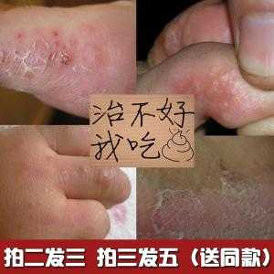 孕期脚气脚痒怎么办啊(怀孕了脚气很痒怎么办,怀孕了脚气发作怎么办) 第1张 孕期脚气脚痒怎么办啊(怀孕了脚气很痒怎么办,怀孕了脚气发作怎么办) 第1张