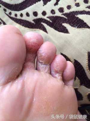 孕期脚气脚痒怎么办啊(怀孕了脚气很痒怎么办,怀孕了脚气发作怎么办) 第2张 孕期脚气脚痒怎么办啊(怀孕了脚气很痒怎么办,怀孕了脚气发作怎么办) 第2张