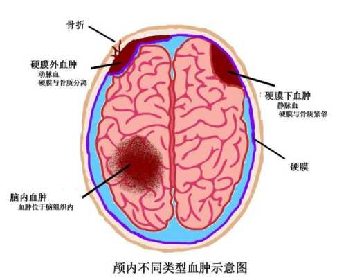 胎儿颅内出血（胎儿颅内出血原因）  第1张