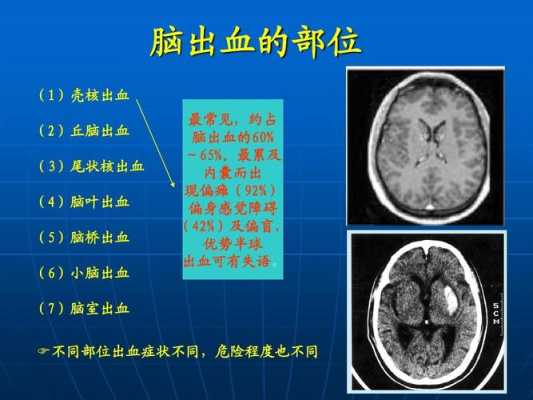 胎儿颅内出血（胎儿颅内出血原因）  第2张