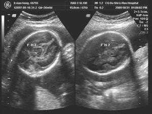 胎儿心脏异常孕期表现（怀孕七个月胎儿心脏室间隔穿隔血流怎么回事）  第2张