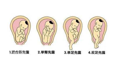 胎儿臀位图（胎儿臀位图片）  第3张