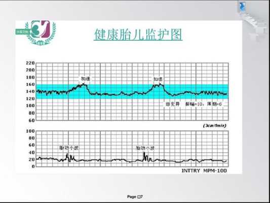 胎儿电子监护(EICU是什么意思) 第1张 胎儿电子监护(EICU是什么意思) 第1张