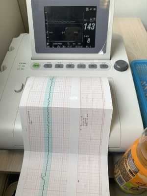 胎儿电子监护(EICU是什么意思) 第3张 胎儿电子监护(EICU是什么意思) 第3张