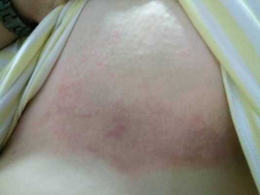 怀孕期间乳房痒是怎么回事(孕期胸痒越抓越痒怎么缓解) 第1张 怀孕期间乳房痒是怎么回事(孕期胸痒越抓越痒怎么缓解) 第1张