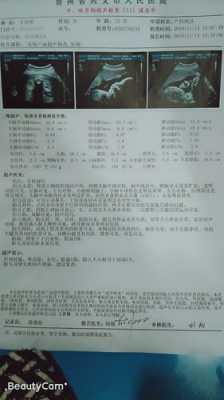 胎儿肾盂轻度增宽要紧吗,胎儿双肾增大回声增强这孩子能要吗 第1张 胎儿肾盂轻度增宽要紧吗,胎儿双肾增大回声增强这孩子能要吗 第1张