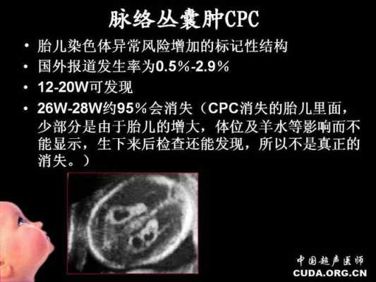 胎儿左侧脉络丛囊肿(胎儿左侧脉络丛囊肿是什么引起的) 第2张 胎儿左侧脉络丛囊肿(胎儿左侧脉络丛囊肿是什么引起的) 第2张