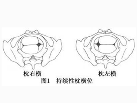 39周胎位头位(左枕横位)不晓得是什么意思,30周胎儿横位还能转过来吗 第2张 39周胎位头位(左枕横位)不晓得是什么意思,30周胎儿横位还能转过来吗 第2张