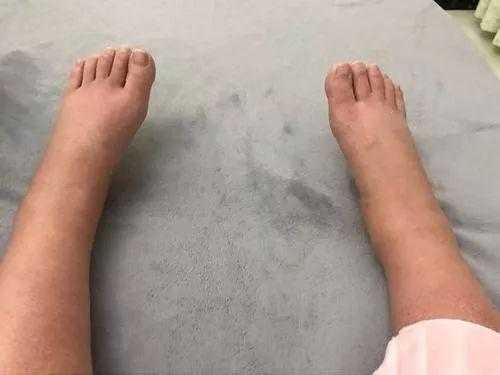 孕期小腿酸胀(怀孕了腿肿怎么办) 第1张 孕期小腿酸胀(怀孕了腿肿怎么办) 第1张