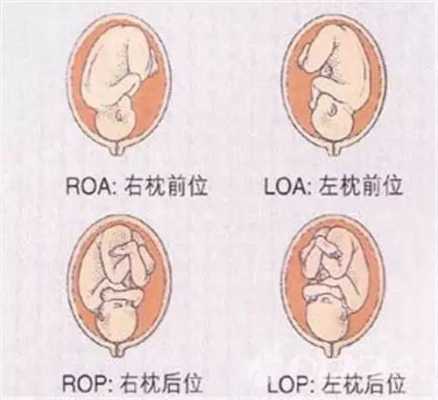 左枕位胎儿图(胎方位:LOP是什么意思) 第3张 左枕位胎儿图(胎方位:LOP是什么意思) 第3张
