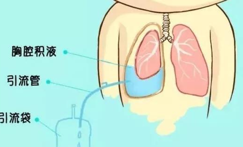 胎儿胸腔积液怎么办(胎儿胸腔积液怎么办,能要吗) 第1张 胎儿胸腔积液怎么办(胎儿胸腔积液怎么办,能要吗) 第1张