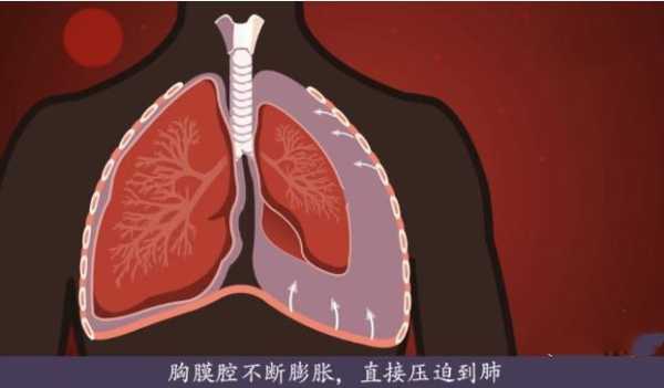 胎儿胸腔积液怎么办(胎儿胸腔积液怎么办,能要吗) 第2张 胎儿胸腔积液怎么办(胎儿胸腔积液怎么办,能要吗) 第2张