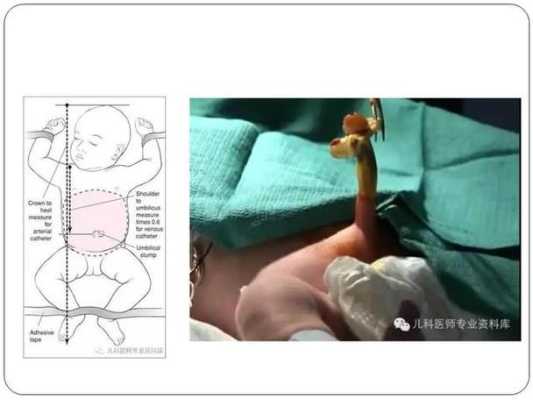 胎儿静脉导管缺失（桩基导管要做什么检测）  第1张