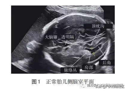 左侧侧脑室增宽是什么原因导致的,胎儿侧脑室增宽原因是什么  第1张