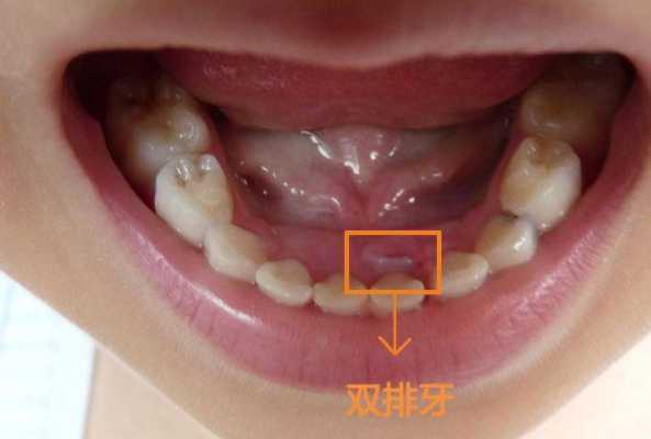 宝宝下面2颗牙出来后，要多久才长上面的牙齿呢,两个月胎儿多大图片正常  第2张