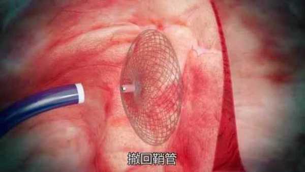 胎儿卵圆孔早闭(新生儿卵圆孔未闭怎么治疗) 第2张 胎儿卵圆孔早闭(新生儿卵圆孔未闭怎么治疗) 第2张