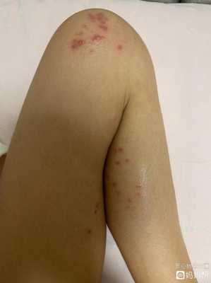 孕期腿上长疙瘩是胎毒(孕期腿上长疙瘩是胎毒图片) 第2张 孕期腿上长疙瘩是胎毒(孕期腿上长疙瘩是胎毒图片) 第2张