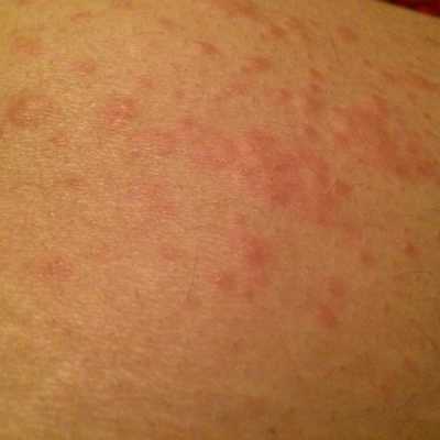 孕期肚皮痒可以挠吗(孕期肚皮痒可以挠吗) 第2张 孕期肚皮痒可以挠吗(孕期肚皮痒可以挠吗) 第2张