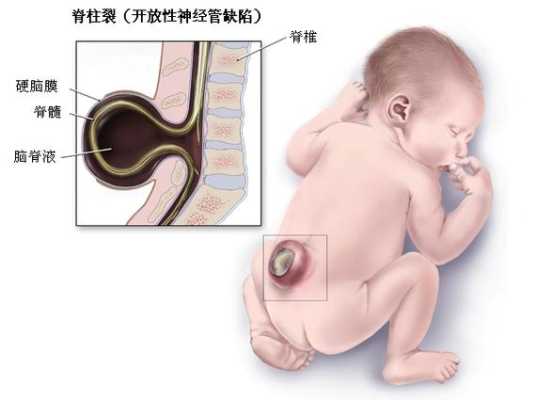 胎儿闭合性脊柱裂(脊柱裂是什么病) 第2张 胎儿闭合性脊柱裂(脊柱裂是什么病) 第2张