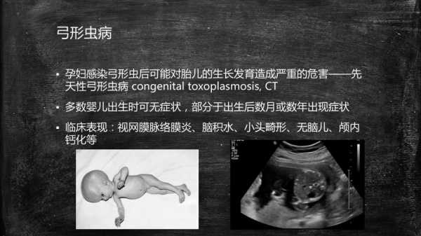 孕妇感染弓形虫后会有哪些症状,孕晚期弓形虫对胎儿的影响 第3张 孕妇感染弓形虫后会有哪些症状,孕晚期弓形虫对胎儿的影响 第3张